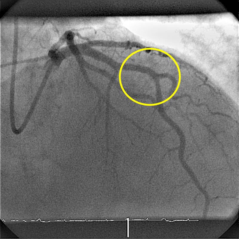 RIVA nach Stent